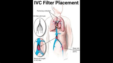 IVC Filter Placement live | IVC Filter Placement Femoral Route to prevent Pulmonary Embolism in ...