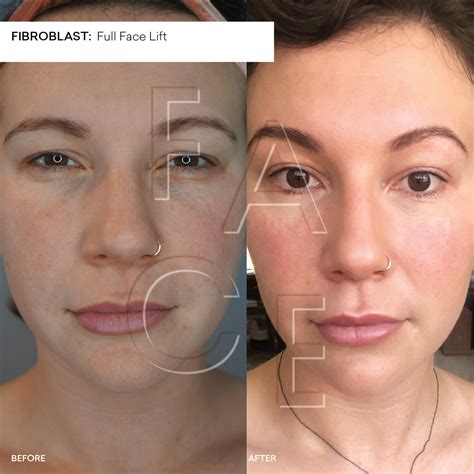 Plasma Fibroblast Before and After Results | Oakland & LA — FACE