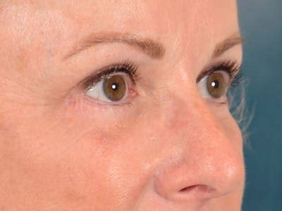 Patient 158443150 | Eyelid Lift Before & After Images | Dr. Sidney Starkman