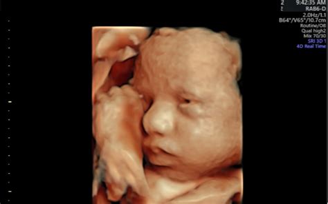 3D ULTRASOUND & 4D ULTRASOUND SYDNEY NSW