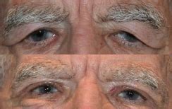 Eyelid Surgery Niles | Ptosis Norwood Park | Dermatochalasis IL