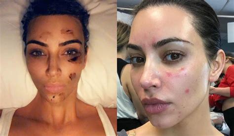 See the terrible Skin disease Kim Kardashian is battling with (Photos) | Theinfong