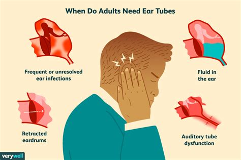 Ear Tube Placement in Adults: Preparation, Procedure, Recovery