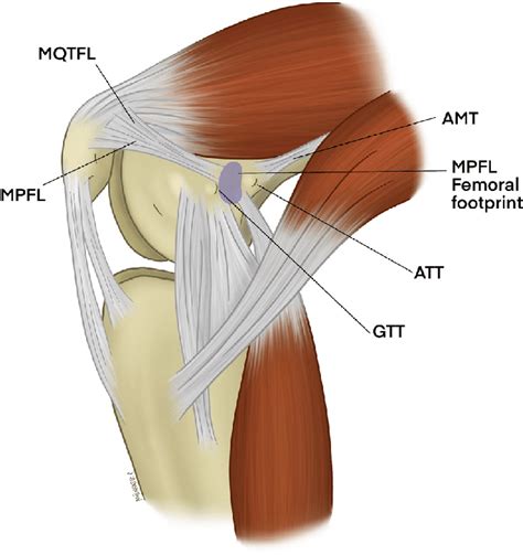 Medial Patellofemoral Ligament Injury MPFL Tear MPFL Insufficiency Orthopedic Knee Specialist ...