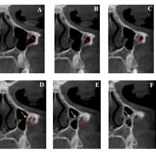 Infraorbital canal was detected in the maxillary sinus; A. Axial plane;... | Download Scientific ...