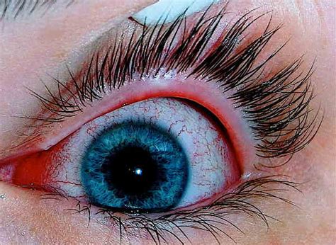 Medical Basics: Is it "Pink Eye"? - PrepperSoft