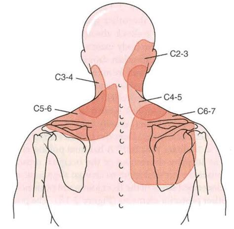 Neck pain treatment - Manor Chiropractic