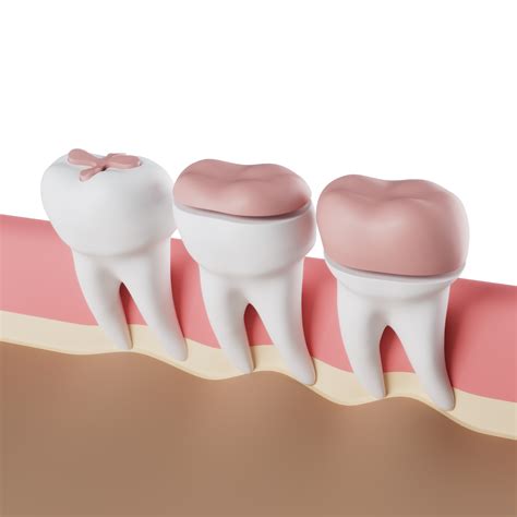 Dental Inlays & Onlays - Materials, Procedure & Costs