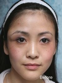 Beverly Hills Asian Eyelid Surgery Before and After Photos - CA Plastic Surgery Photo Gallery ...