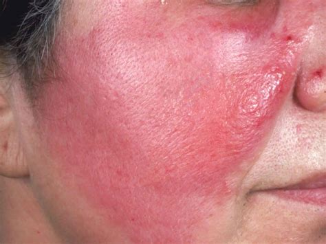 Skin Infection, Causes, Symptoms, Diagnosis Treatment, 55% OFF