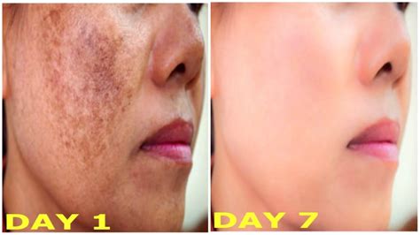 How To Remove Dark Spots On Face And Pimples - HOWTOREMVO