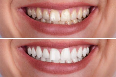 Teeth whitening vs teeth cleaning - Hamilton Dental Centre