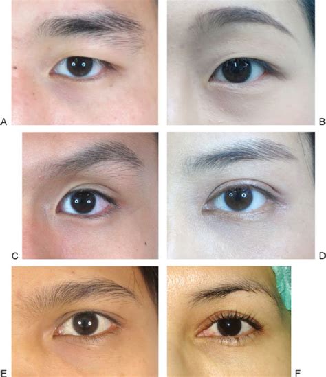 Types Of Eyelids