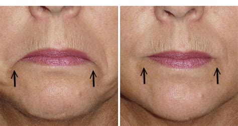 Botox For Upturned Lips | Lipstutorial.org