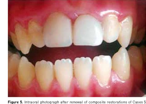 Mineral trioxide aggregate as a pulpotomy agent in immature teeth: Long-term case report ...