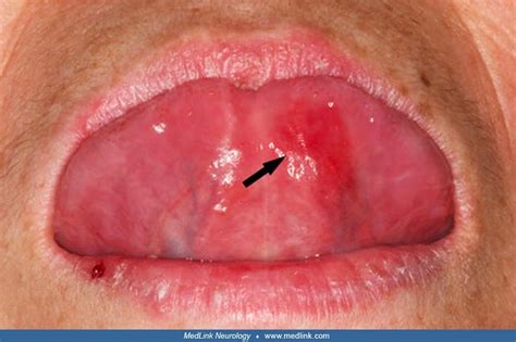Vitamin B12 Deficiency Tongue