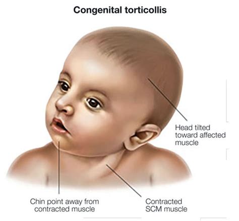 Torticollis