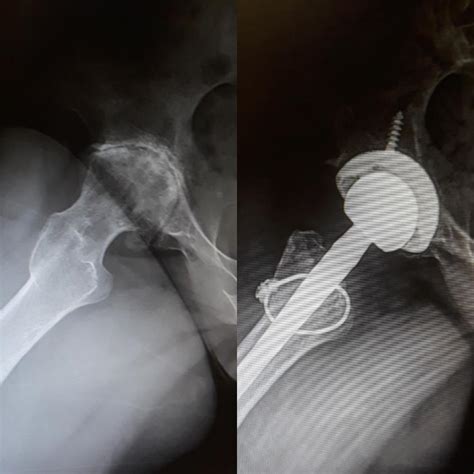 Before and after hip replacement surgery : r/XRayPorn