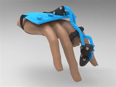 Prosthetic Fingers 3D PRINT PROSTHETIC FINGER, Stl File Diy, Print Your Own Prosthetic Hand - Etsy