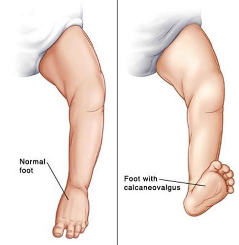 Calcaneovalgus foot causes, symptoms, diagnosis & treatment