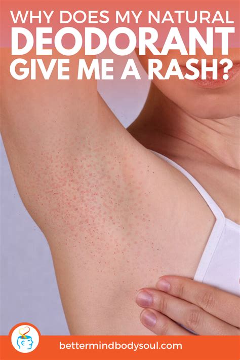 Why Does My Natural Deodorant Give Me a Rash? | Natural deodorant, Heat rash, Armpit rash