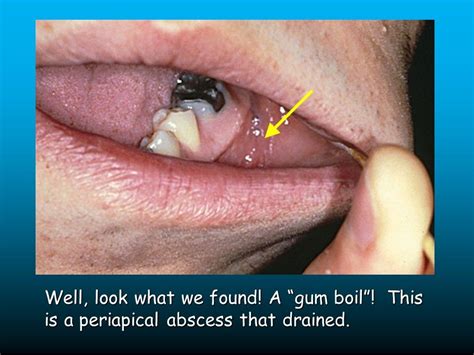 "Lumpy Jaw" in a 20-year-old Male Resists Treatment