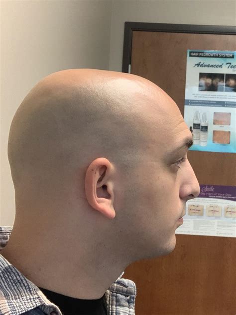 Laser hair removal : r/bald