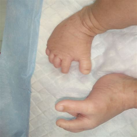 Overgrowth syndrome in neonates: a rare case series with a review of the literature | BMJ Case ...