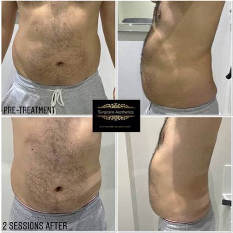 Aqualyx Fat Dissolving Barnet & Marylebone | Surgicare Aesthetics