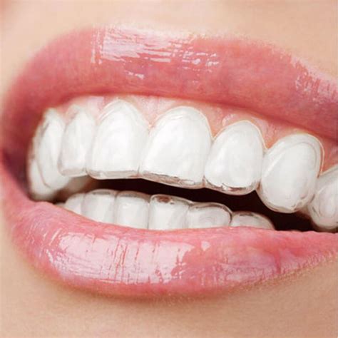 Clear Braces for Adults - Your Ultimate Guide