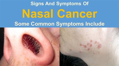 Signs And Symptoms Of Nasal Cancer - YouTube