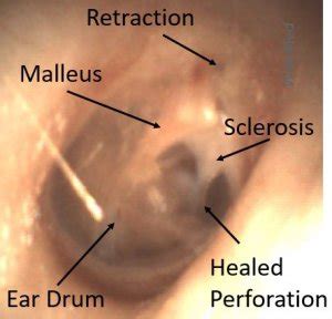 Myringosclerosis - WiscMed