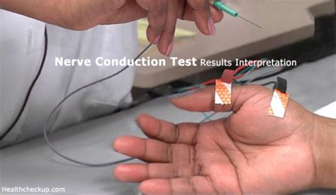 Nerve Conduction Test Results Interpretation - Health CheckUp