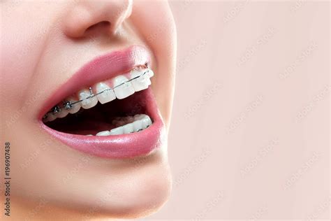 Close up open mouth with Ceramic and Metal Braces on beautiful Teeth ...