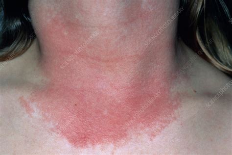 Sudden Burning Rash On Face And Neck - Printable Templates Protal
