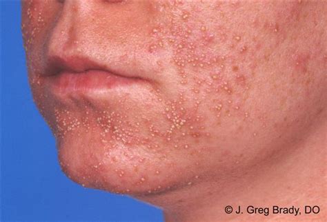 Bacterial Folliculitis On Face