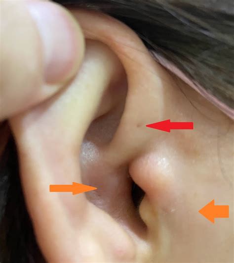 Preauricular Sinus Infection – UNI CLINIC