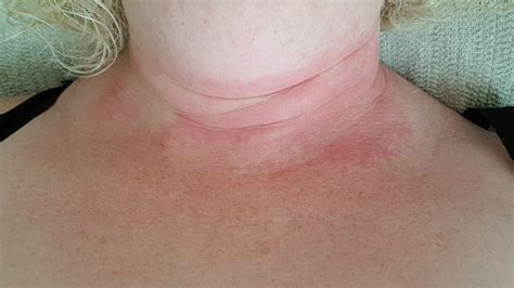 Eczema Type Rash On Breast - Design Talk