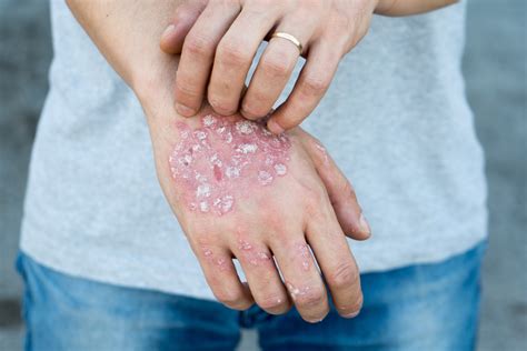 Psoriasis Vulgaris | JNU Hospital