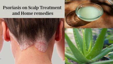 Psoriasis on Scalp Treatment and Home remedies