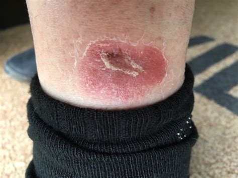 Horrid thing on my leg | Diabetes Forum • The Global Diabetes Community