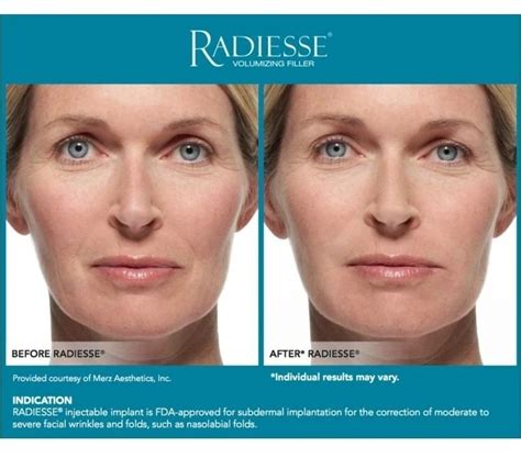 Most Popular Radiesse Hyaluronic Acid Filler Chin Lip Augmentation Nasolabial Fold Reduce ...