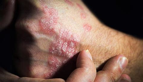 Psoriasis on Hands & Feet (Palmoplantar): Causes & Treatment