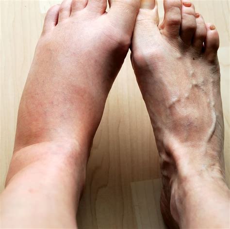 10 Reasons Why You Have Swollen Feet, According to a Doctor | Foot and ankle swelling, Swollen ...