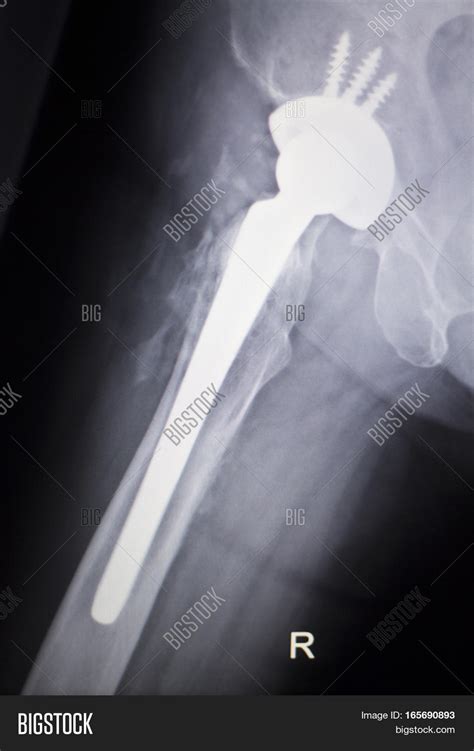 Hip Joint Replacement Image & Photo (Free Trial) | Bigstock