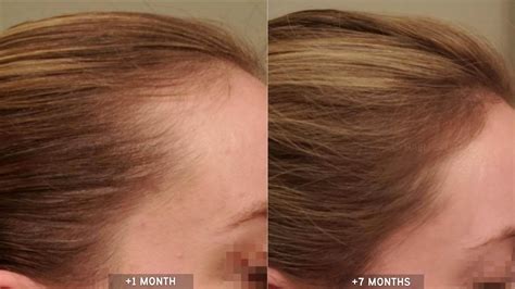 Top 187+ Scalp massage for hair growth before and after ...