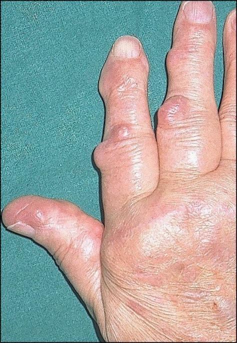 (67-year-old female, right hand): Palmar fibromatosis associated with... | Download Scientific ...