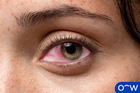 Eye Allergies: Types, Causes, Symptoms, and Treatments