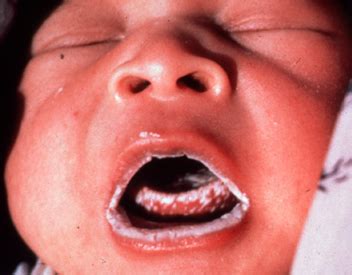 Thrush In Babies: What Is Oral Thrush In Infants And How Is