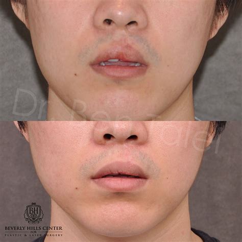 Scar, Piercing & Mole Removal – Before & Afters | Beverly Hills Center